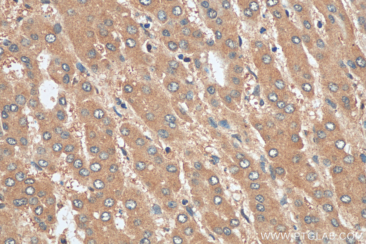 IHC staining of human liver cancer using 12324-1-AP