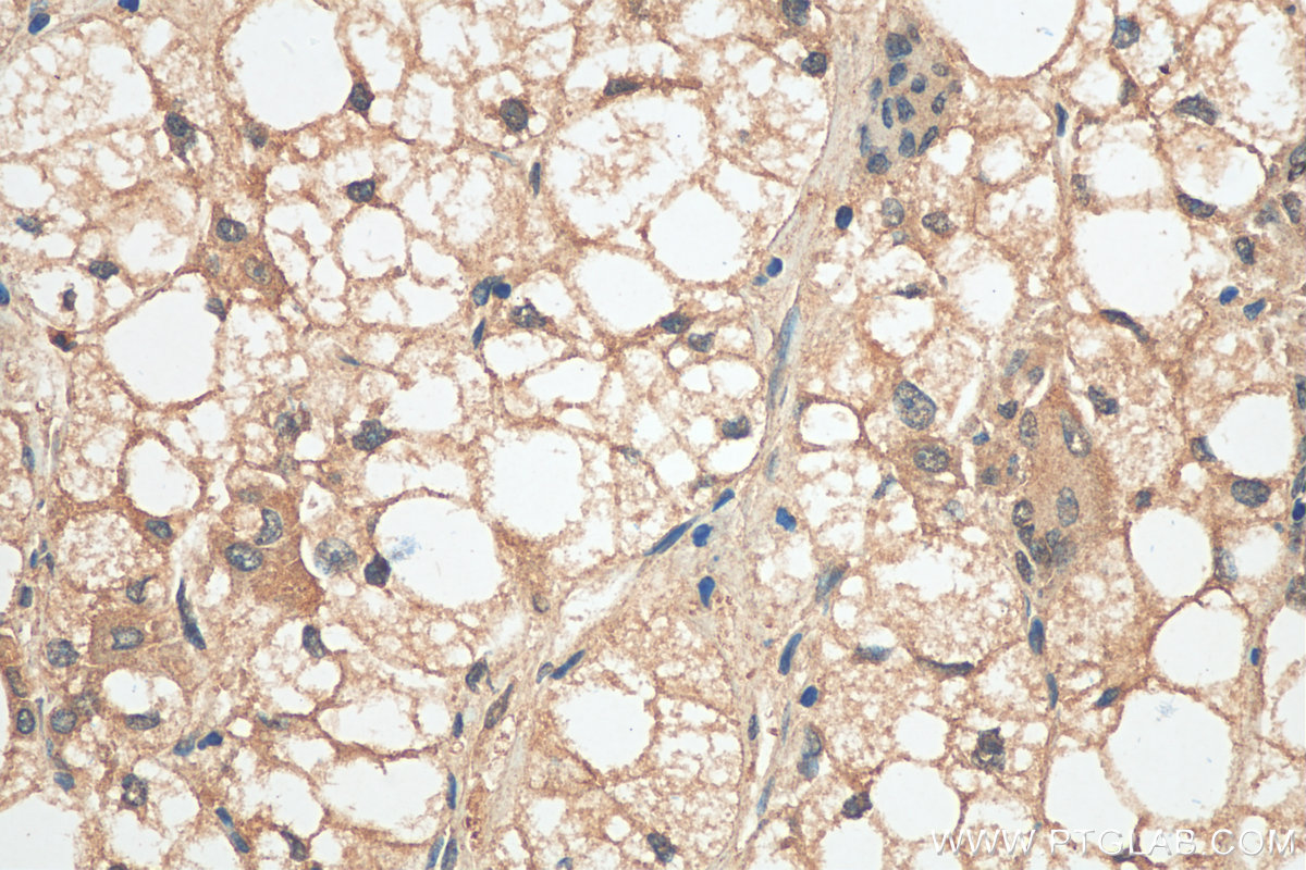 IHC staining of human liver cancer using 12324-1-AP