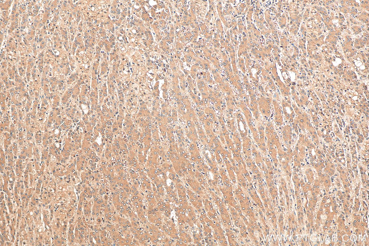 IHC staining of human liver cancer using 12324-1-AP