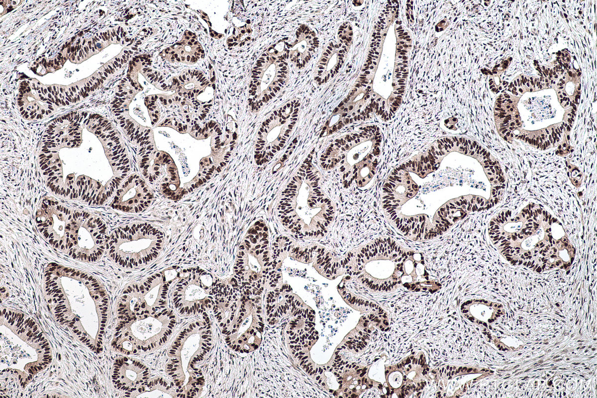 IHC staining of human colon cancer using 16727-1-AP