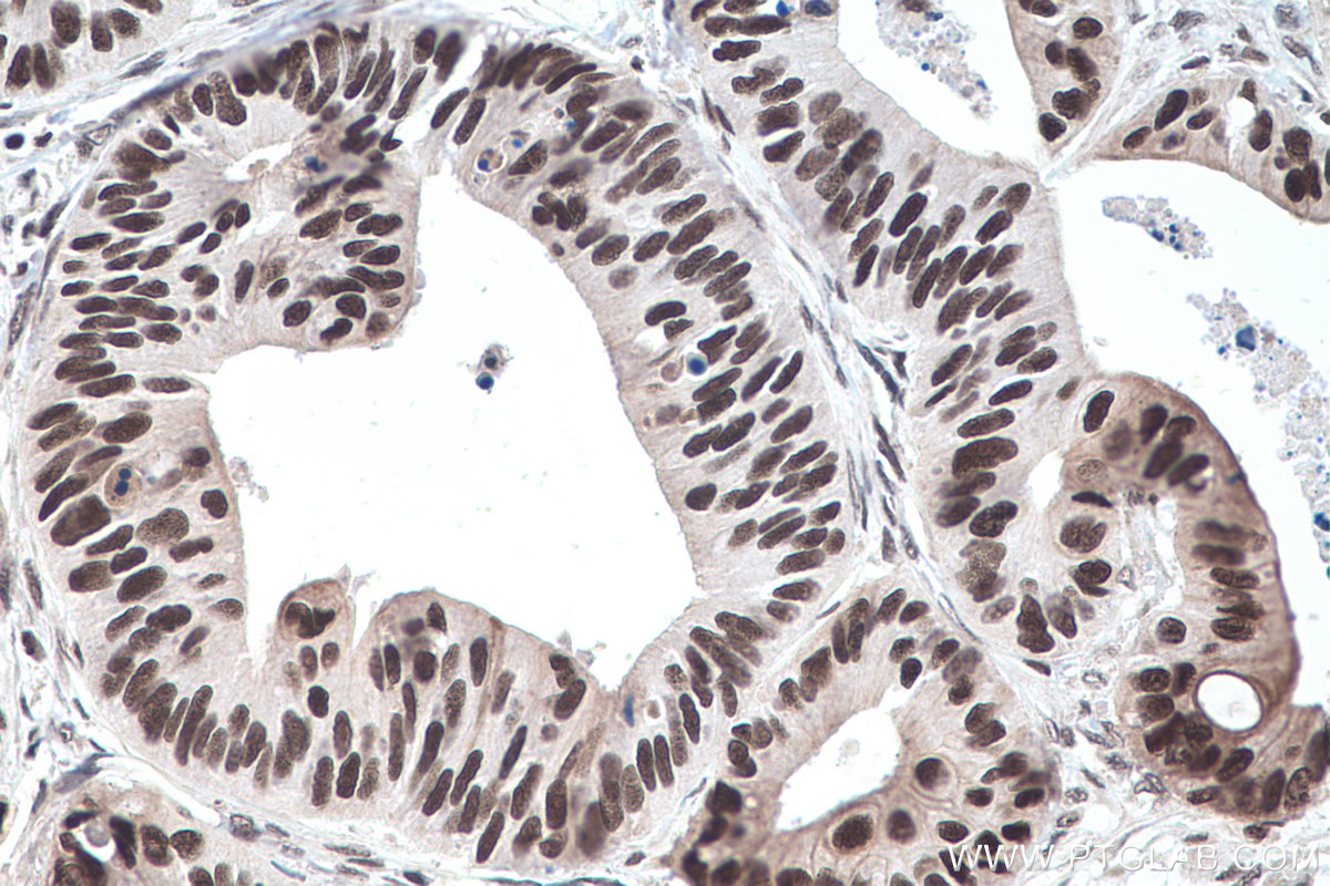 IHC staining of human colon cancer using 16727-1-AP