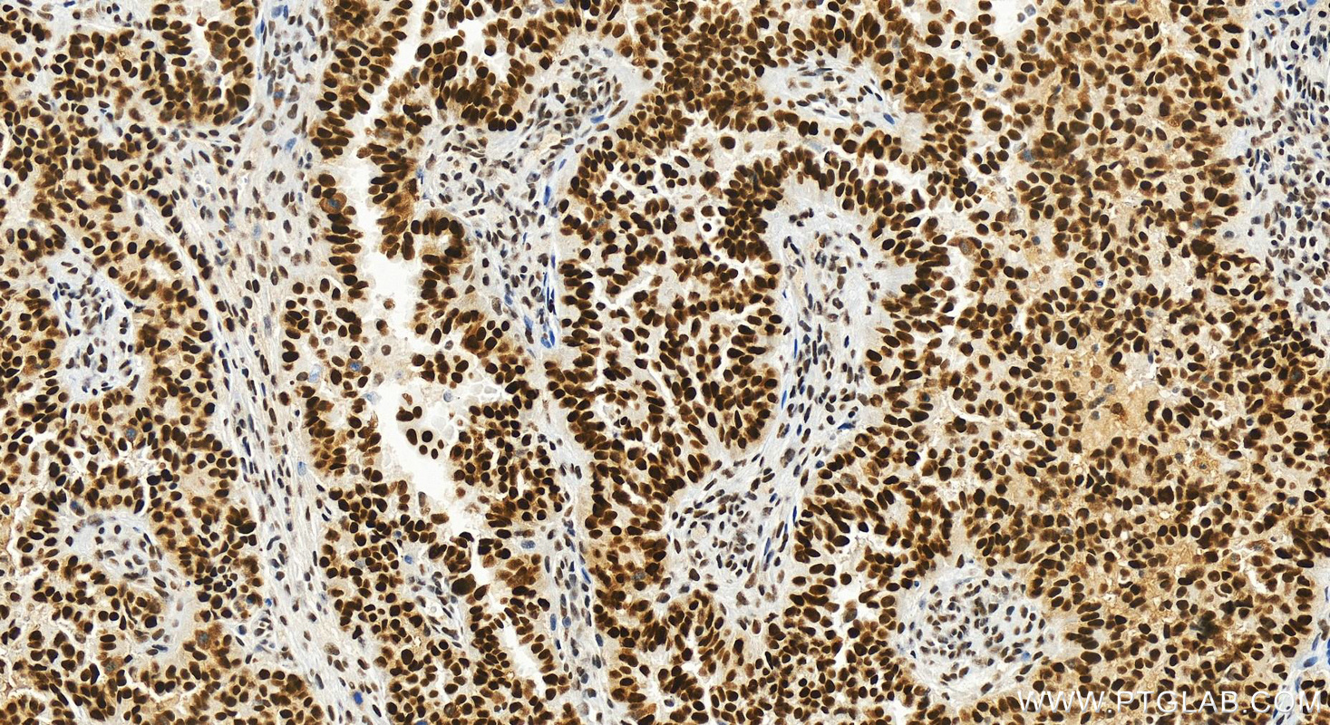 IHC staining of human ovarian  cancer using 83843-5-RR (same clone as 83843-5-PBS)