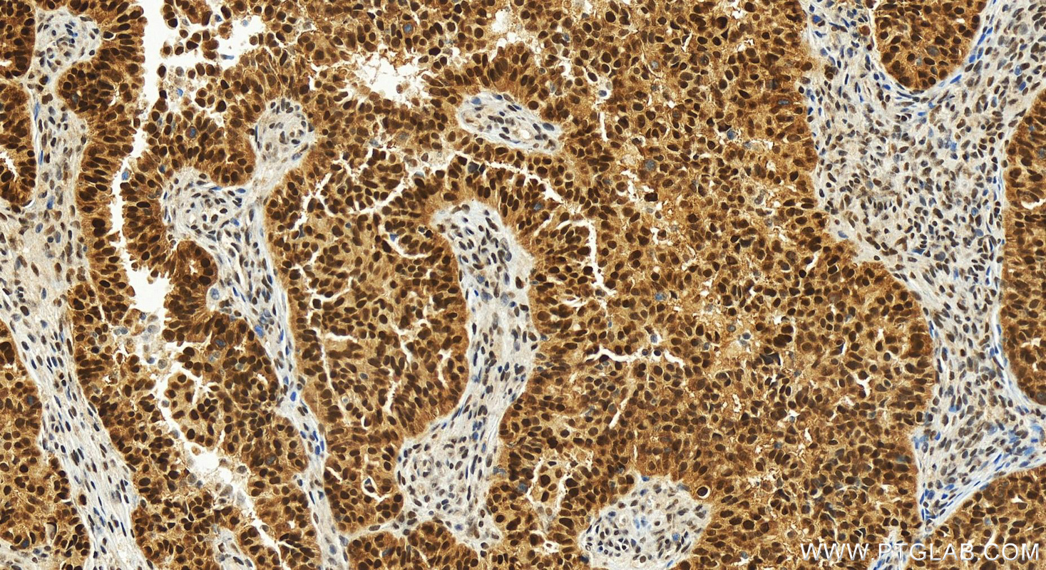 IHC staining of human ovarian  cancer using 83843-6-RR (same clone as 83843-6-PBS)