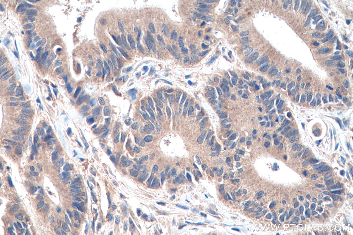 IHC staining of human colon cancer using 26009-1-AP