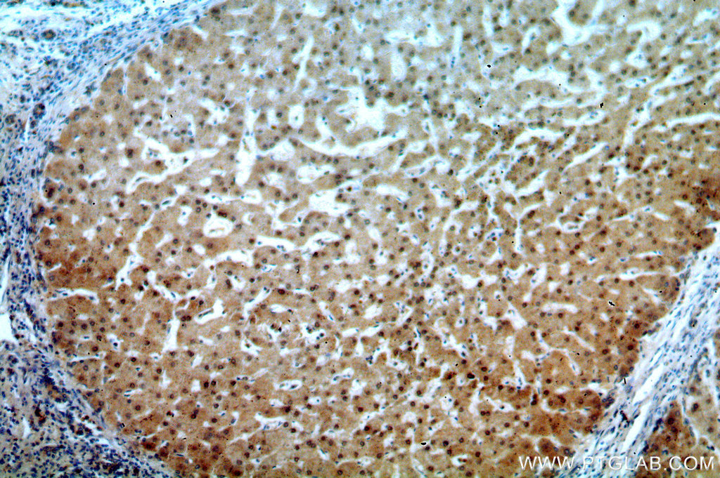 IHC staining of human hepatocirrhosis using 15053-1-AP