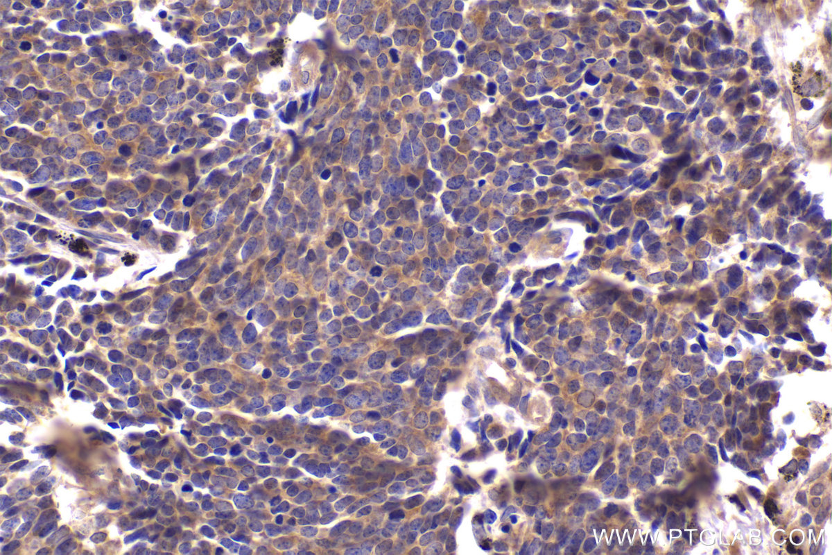 IHC staining of human lung cancer using 68380-1-Ig (same clone as 68380-1-PBS)