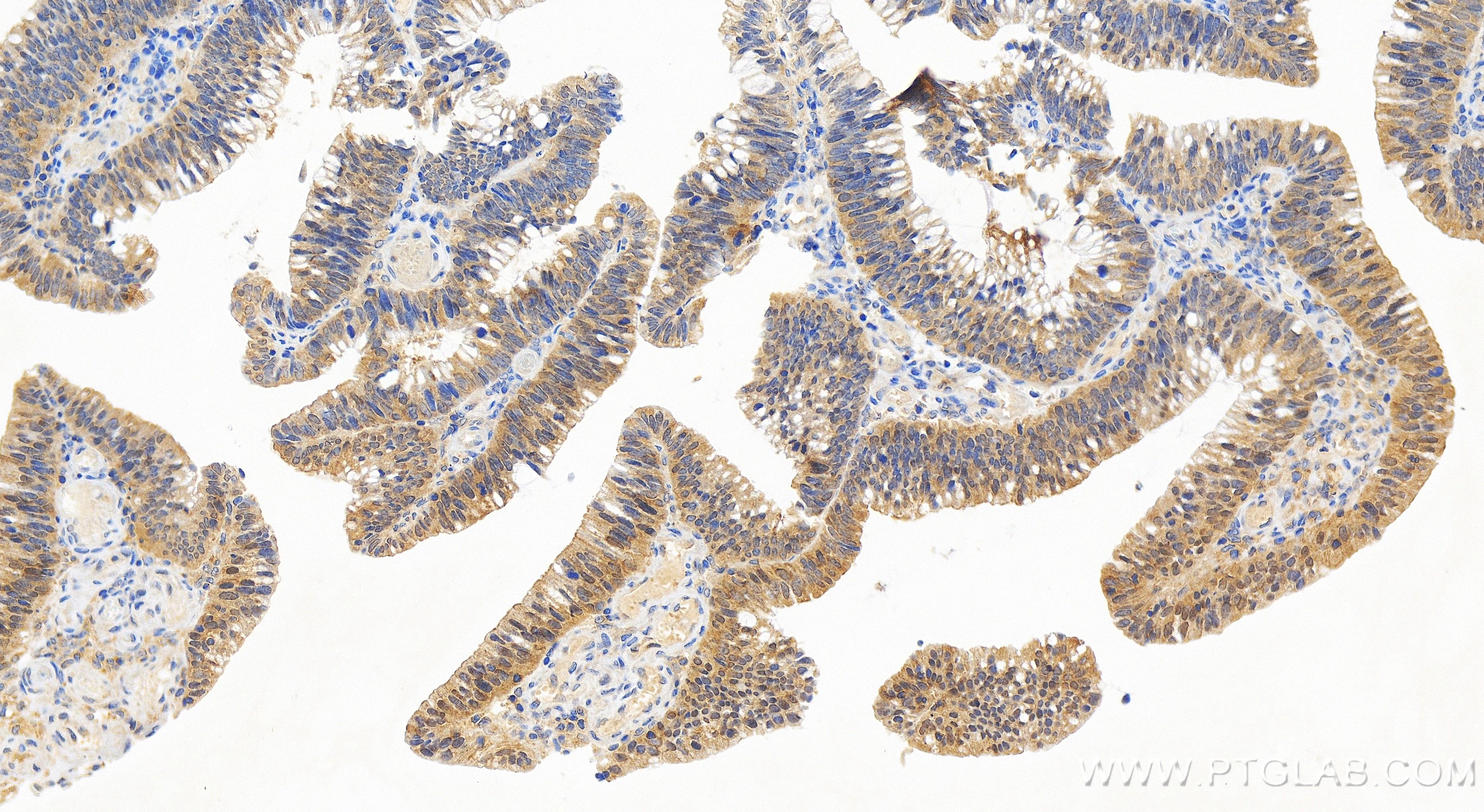 IHC staining of human colon cancer using 84334-4-RR (same clone as 84334-4-PBS)