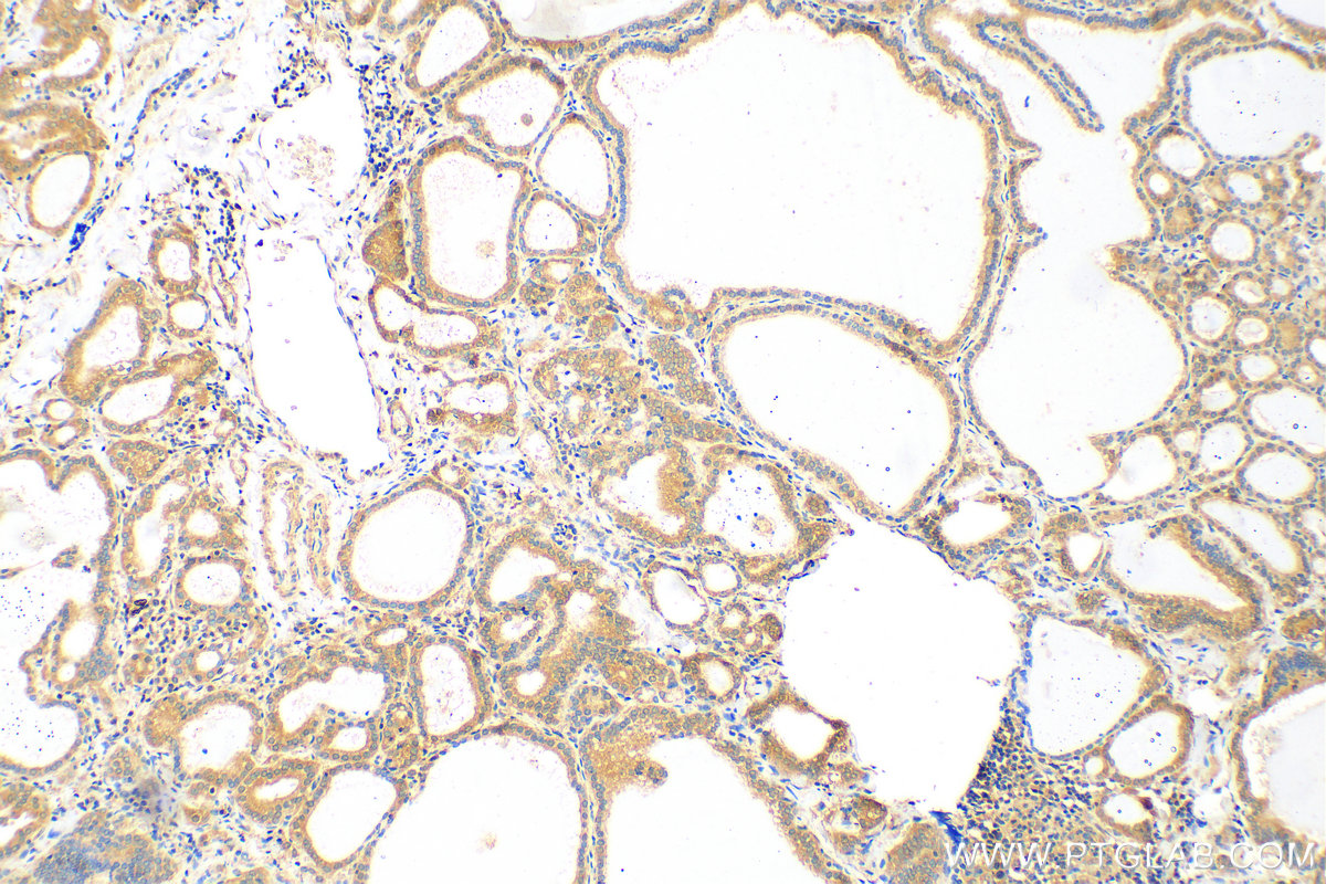 IHC staining of human thyroid cancer using 14450-1-AP