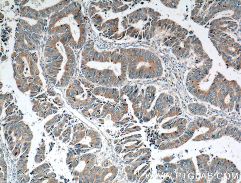 IHC staining of human colon cancer using 12370-1-AP