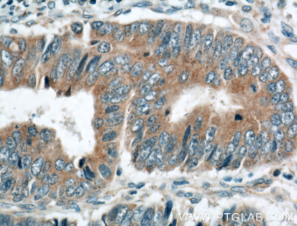 IHC staining of human colon cancer using 12370-1-AP