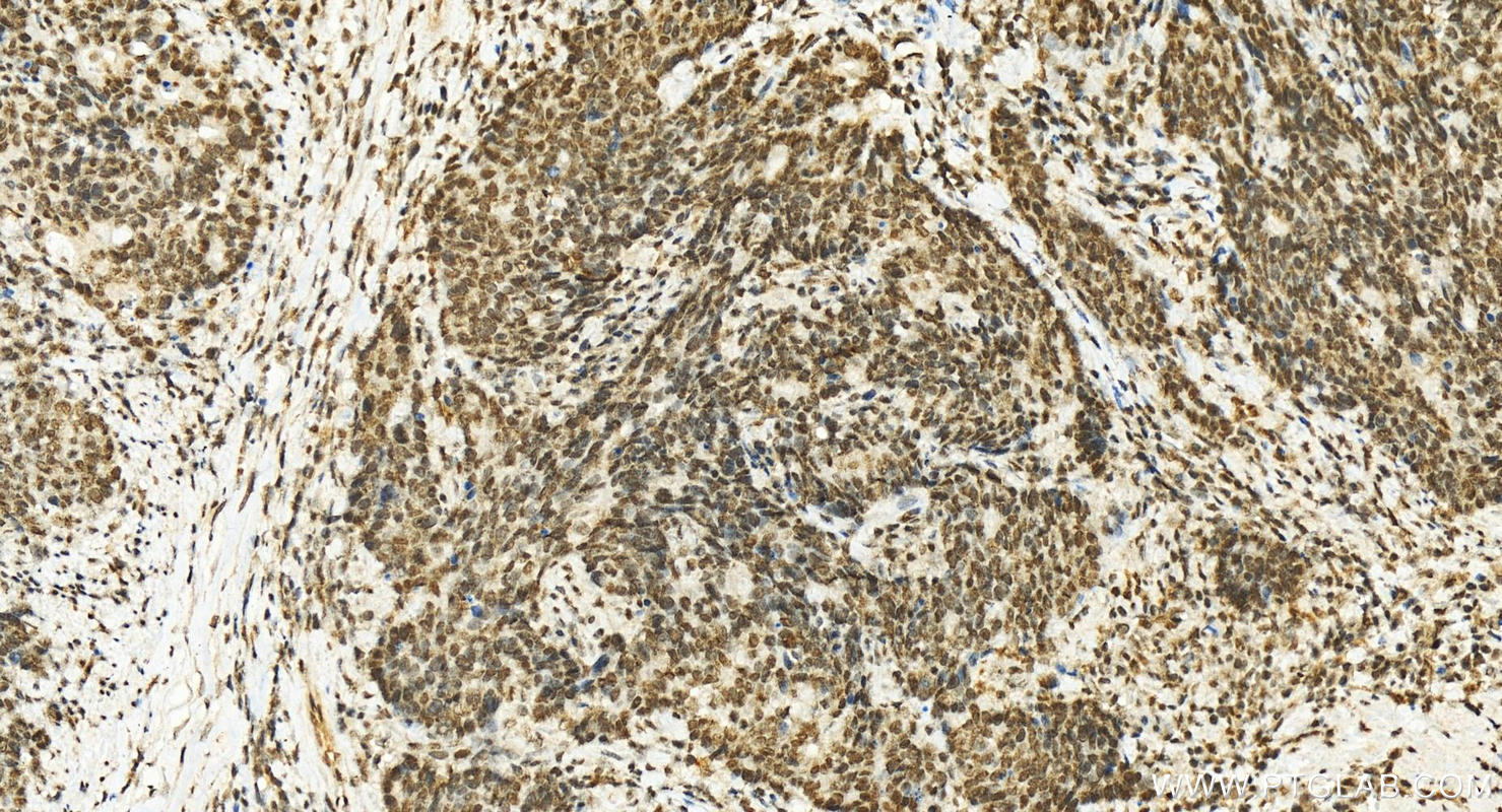 IHC staining of human stomach cancer using 12122-1-AP