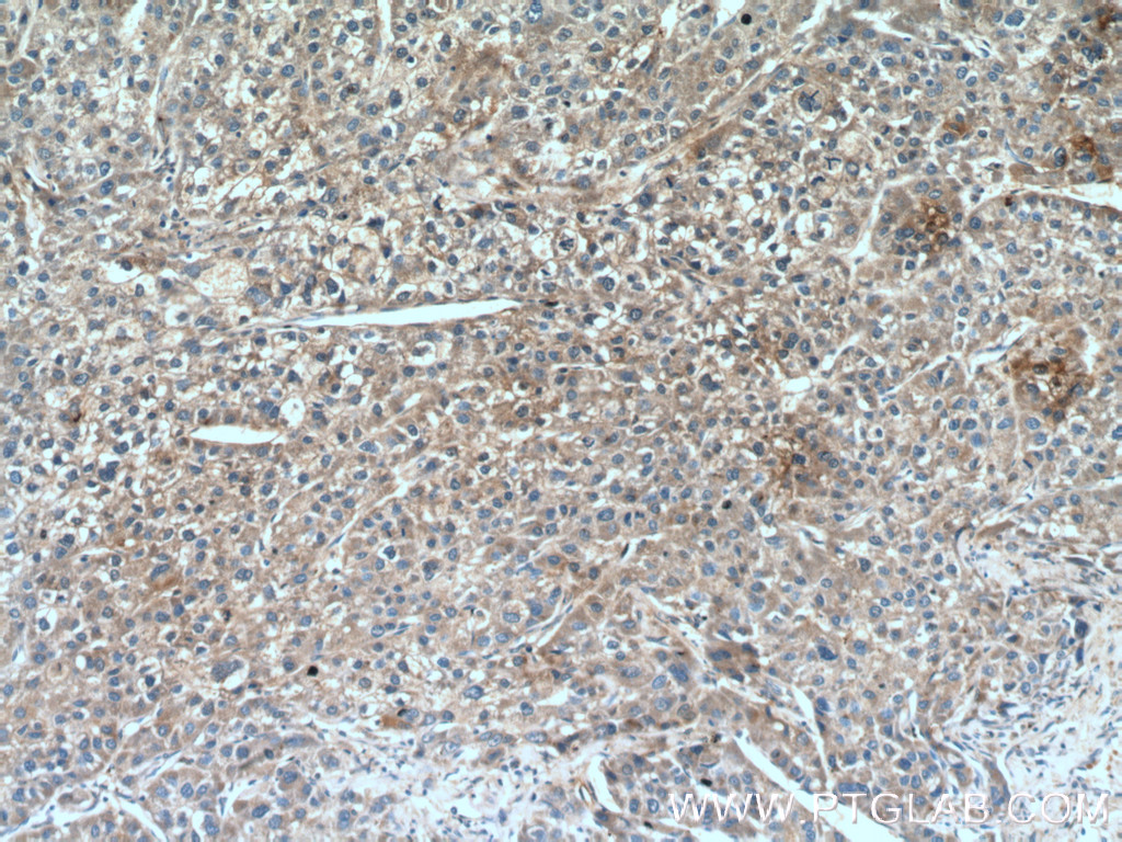 IHC staining of human liver cancer using 12940-1-AP