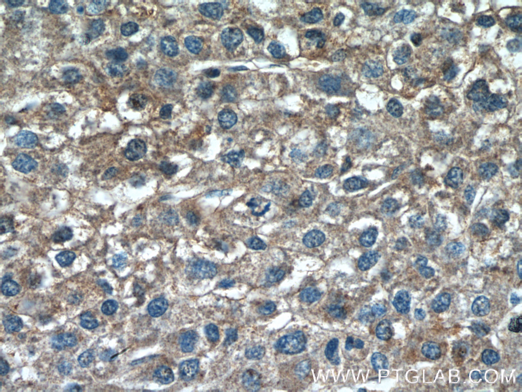 IHC staining of human liver cancer using 12940-1-AP