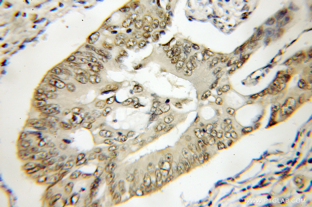 IHC staining of human colon cancer using 11676-1-AP