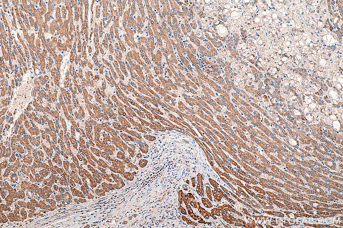 IHC staining of human liver cancer using 23432-1-AP