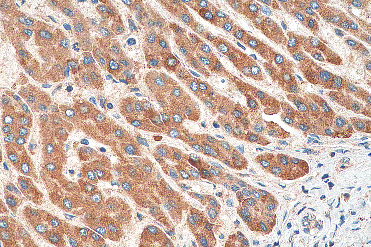 IHC staining of human liver cancer using 23432-1-AP