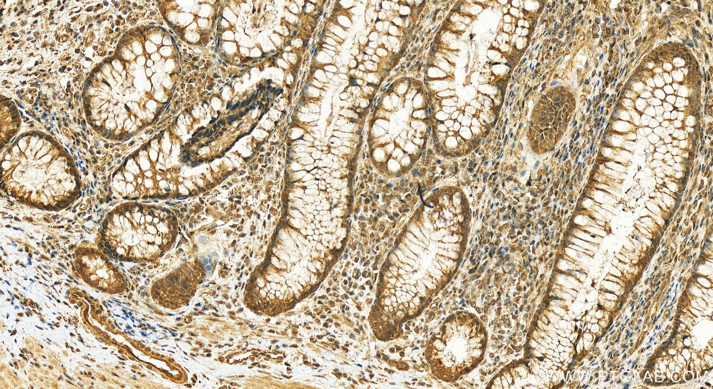 IHC staining of human colon cancer using 26112-1-AP