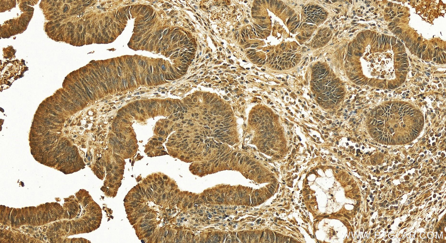 IHC staining of human colon cancer using 26112-1-AP