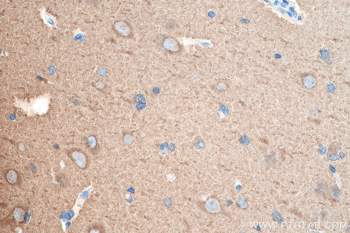 IHC staining of human gliomas using 10063-2-AP