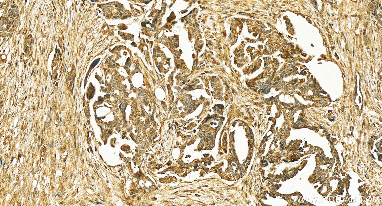 IHC staining of human ovary cancer using 13637-1-AP