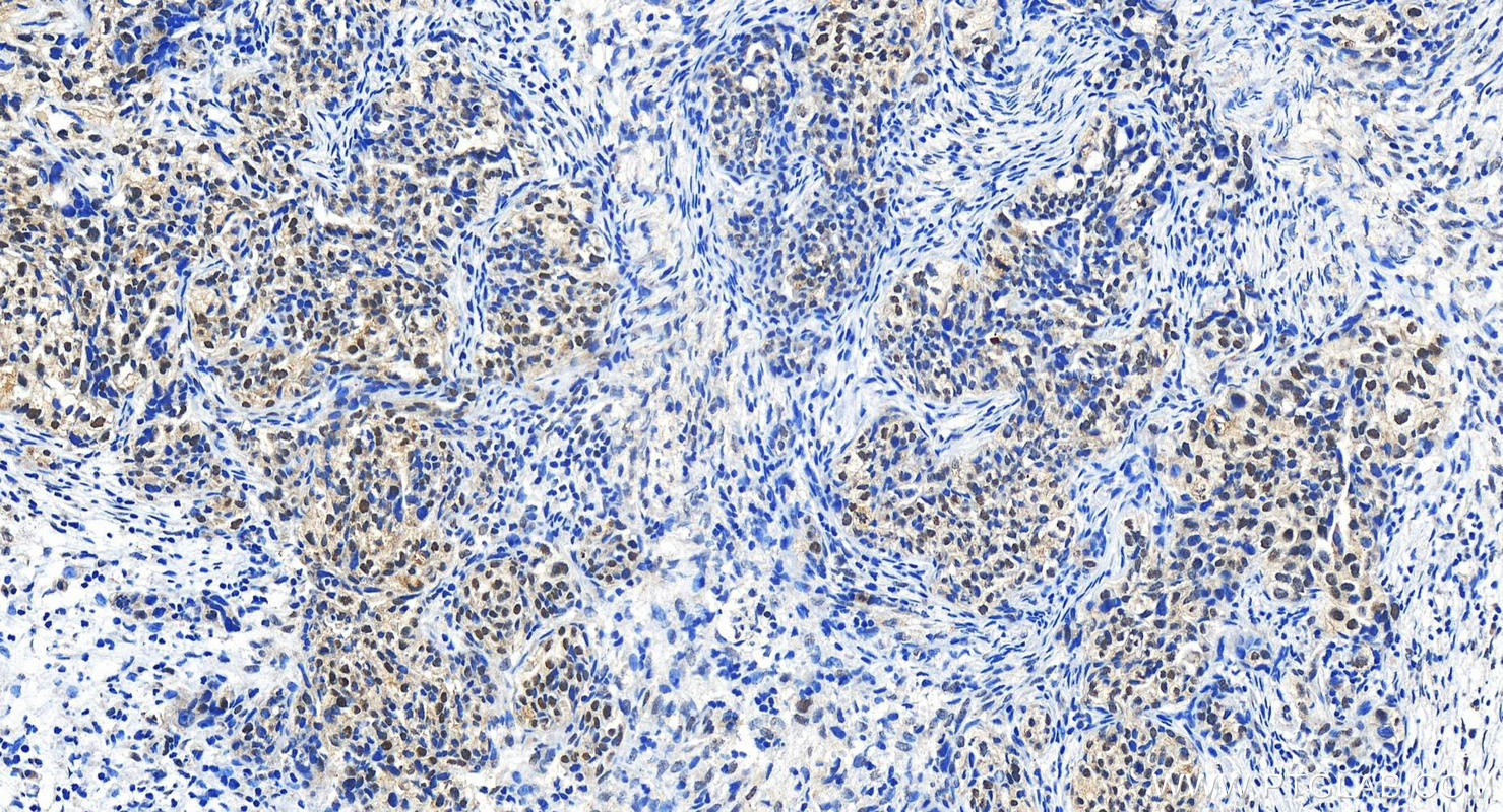 IHC staining of human ovary cancer using 22784-1-AP