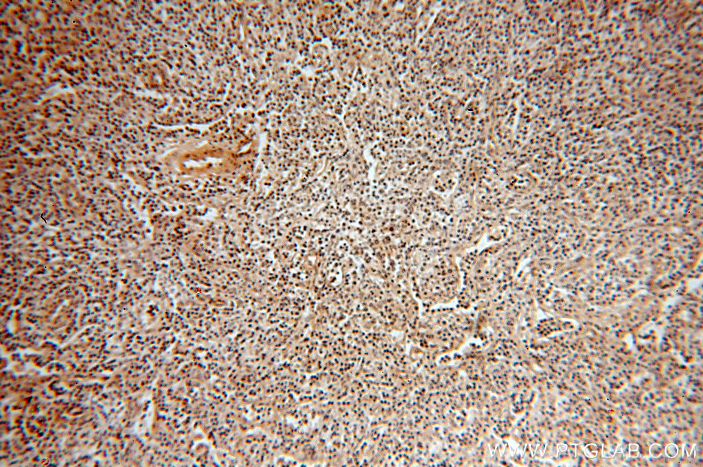 IHC staining of human lymphoma using 18981-1-AP