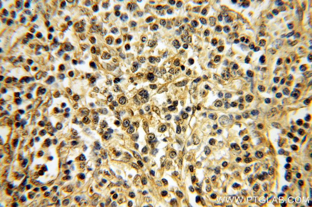 IHC staining of human lymphoma using 18981-1-AP