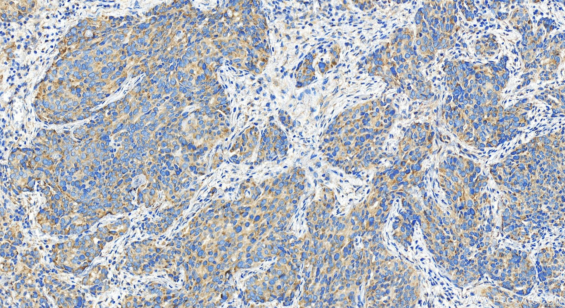 IHC staining of human ovary cancer using 27558-1-AP