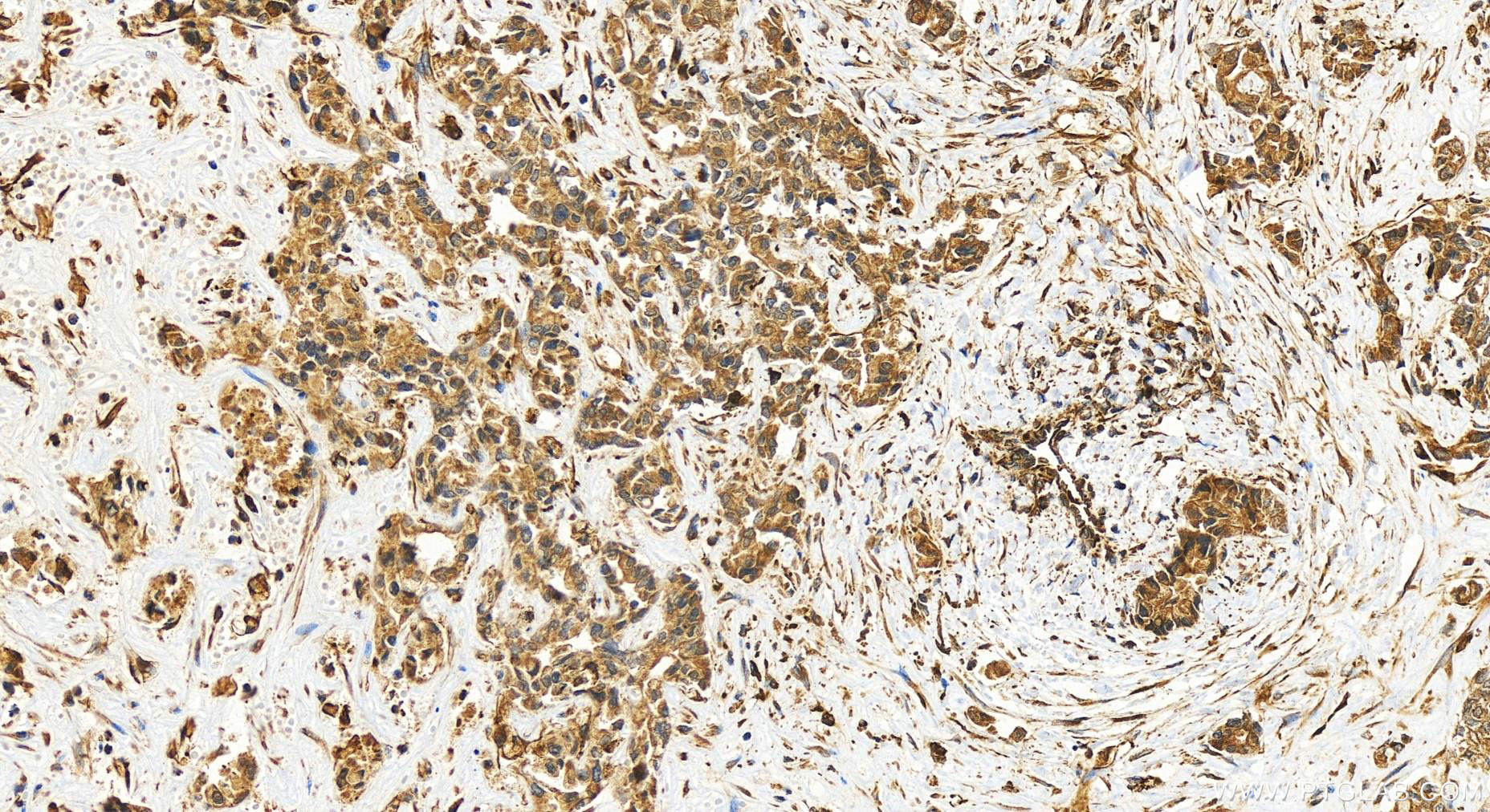 IHC staining of human intrahepatic cholangiocarcinoma using 25687-1-AP