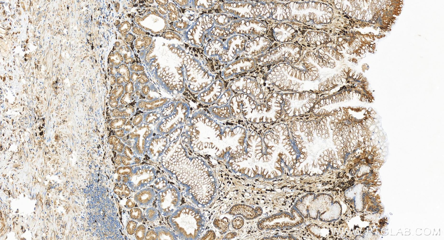 IHC staining of human stomach cancer using 84756-5-RR (same clone as 84756-5-PBS)