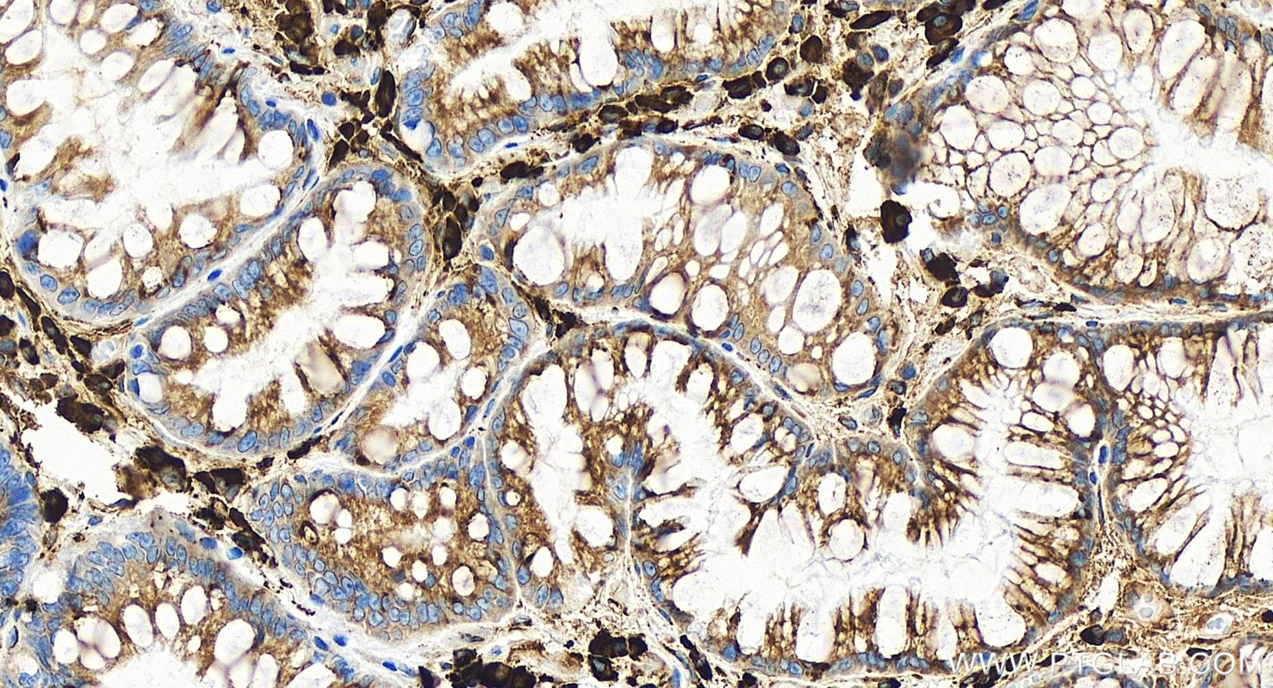 IHC staining of human stomach cancer using 84756-5-RR (same clone as 84756-5-PBS)