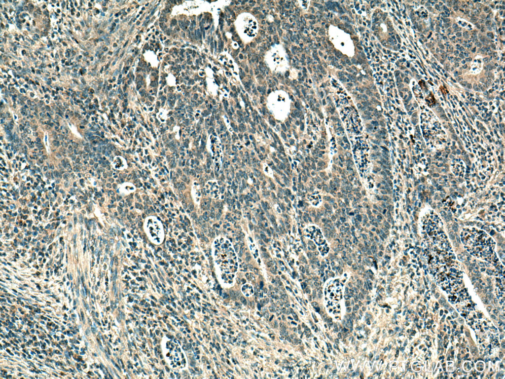 IHC staining of human colon cancer using 67411-1-Ig (same clone as 67411-1-PBS)