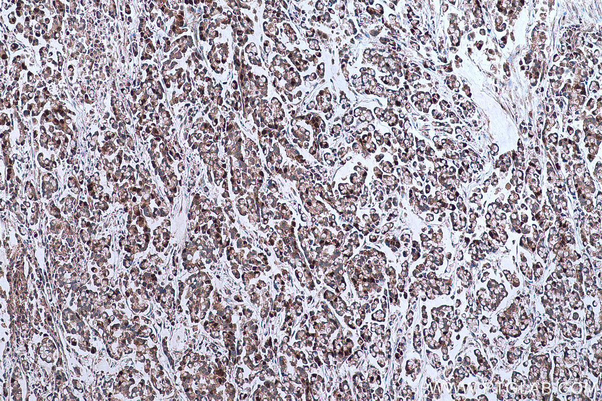 IHC staining of human colon cancer using 66725-1-Ig