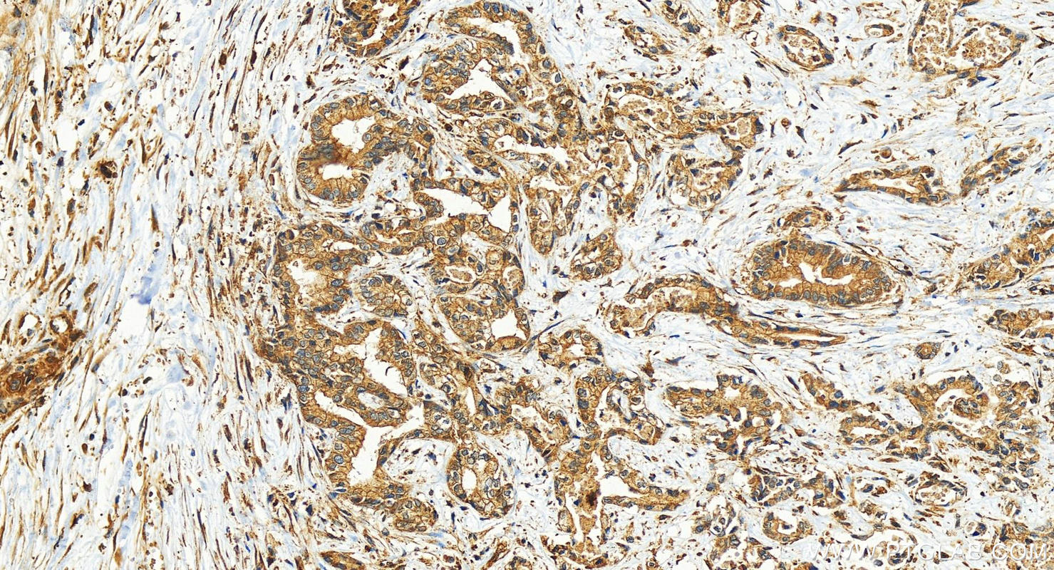 IHC staining of human intrahepatic cholangiocarcinoma using 82856-18-RR