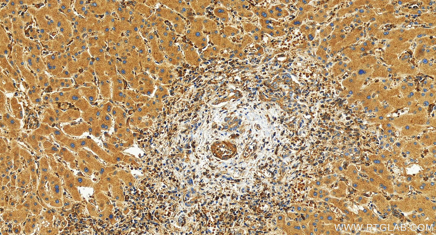 IHC staining of human intrahepatic cholangiocarcinoma using 82856-18-RR