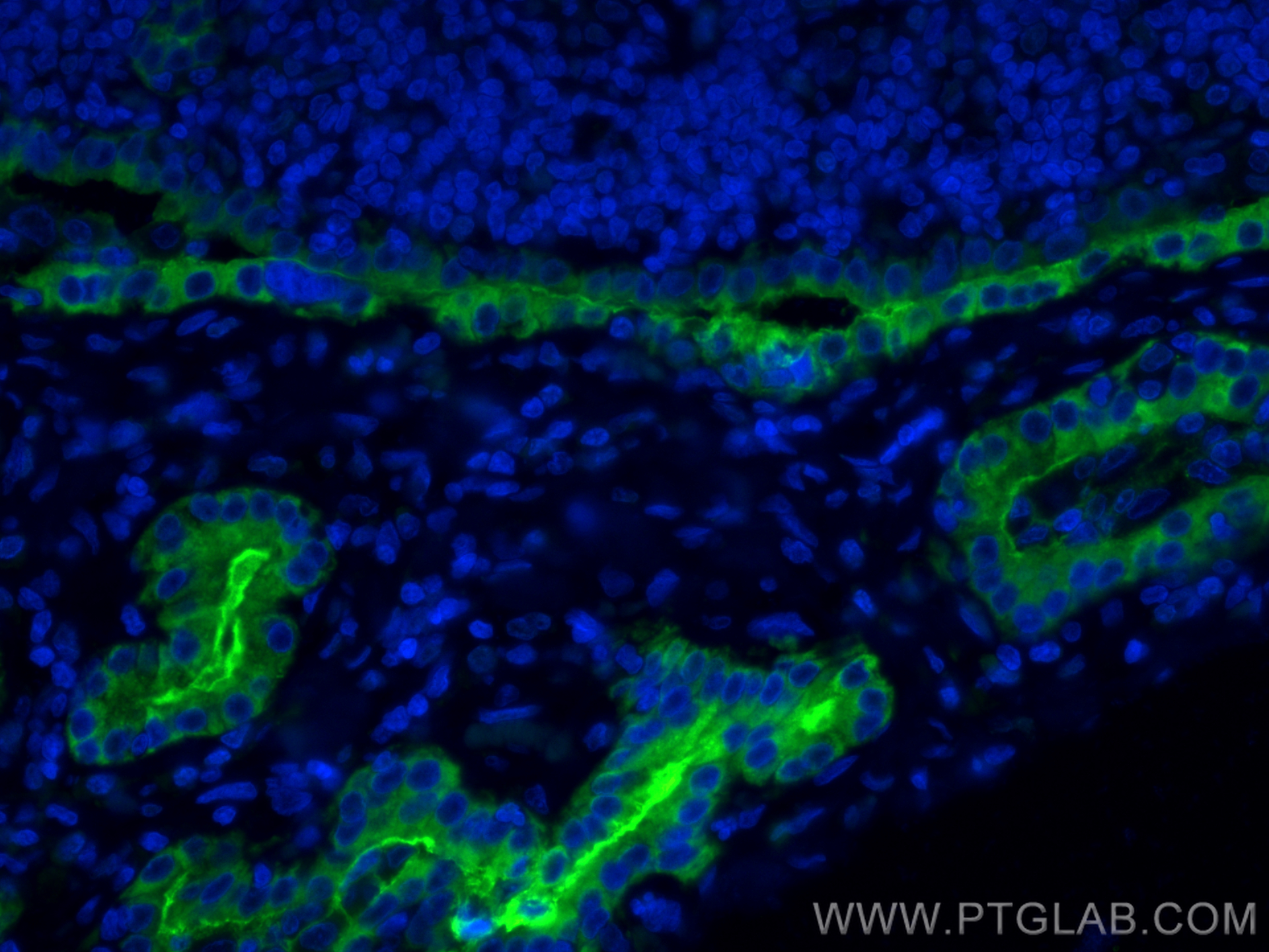 IF Staining of human thyroid cancer using CL488-60272