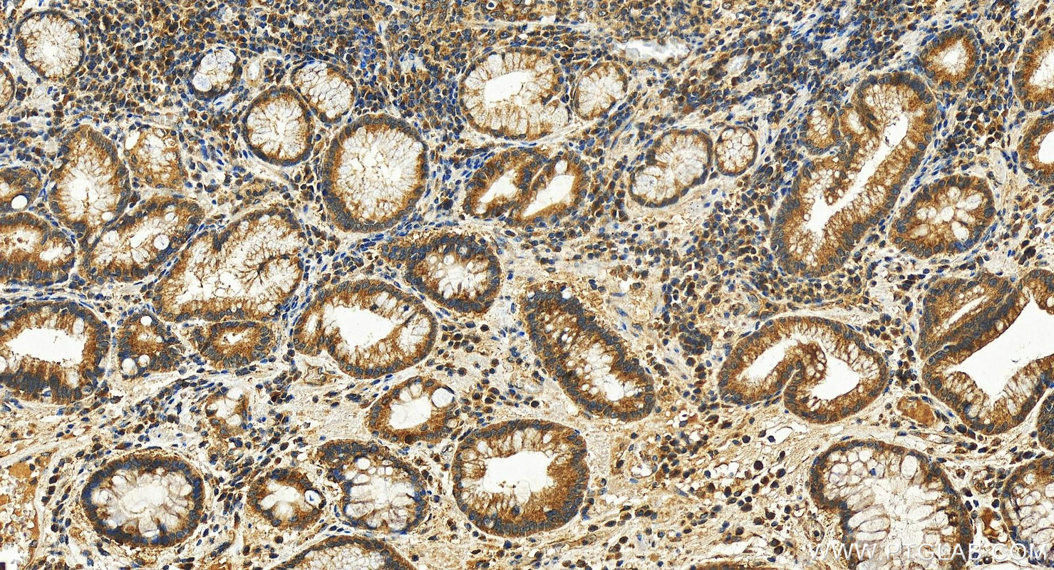 IHC staining of human stomach cancer using 28005-1-AP