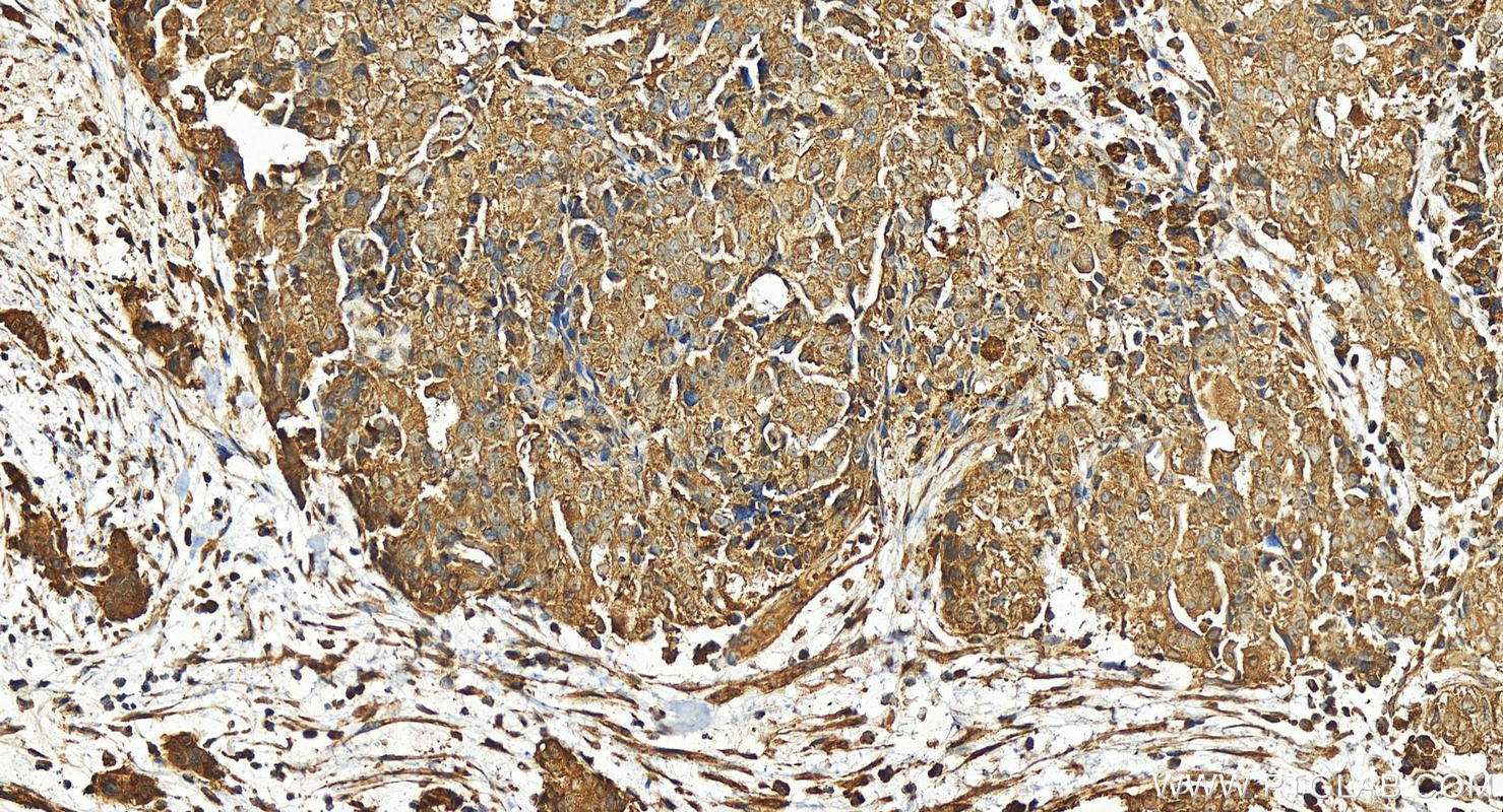 IHC staining of human ovary cancer using 25262-1-AP