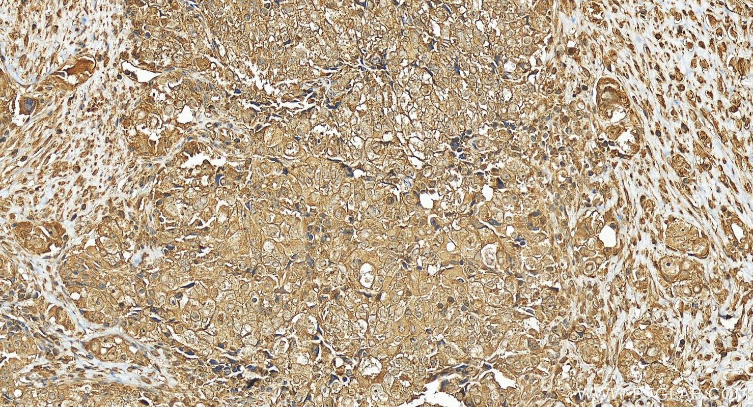 IHC staining of human ovary cancer using 25262-1-AP