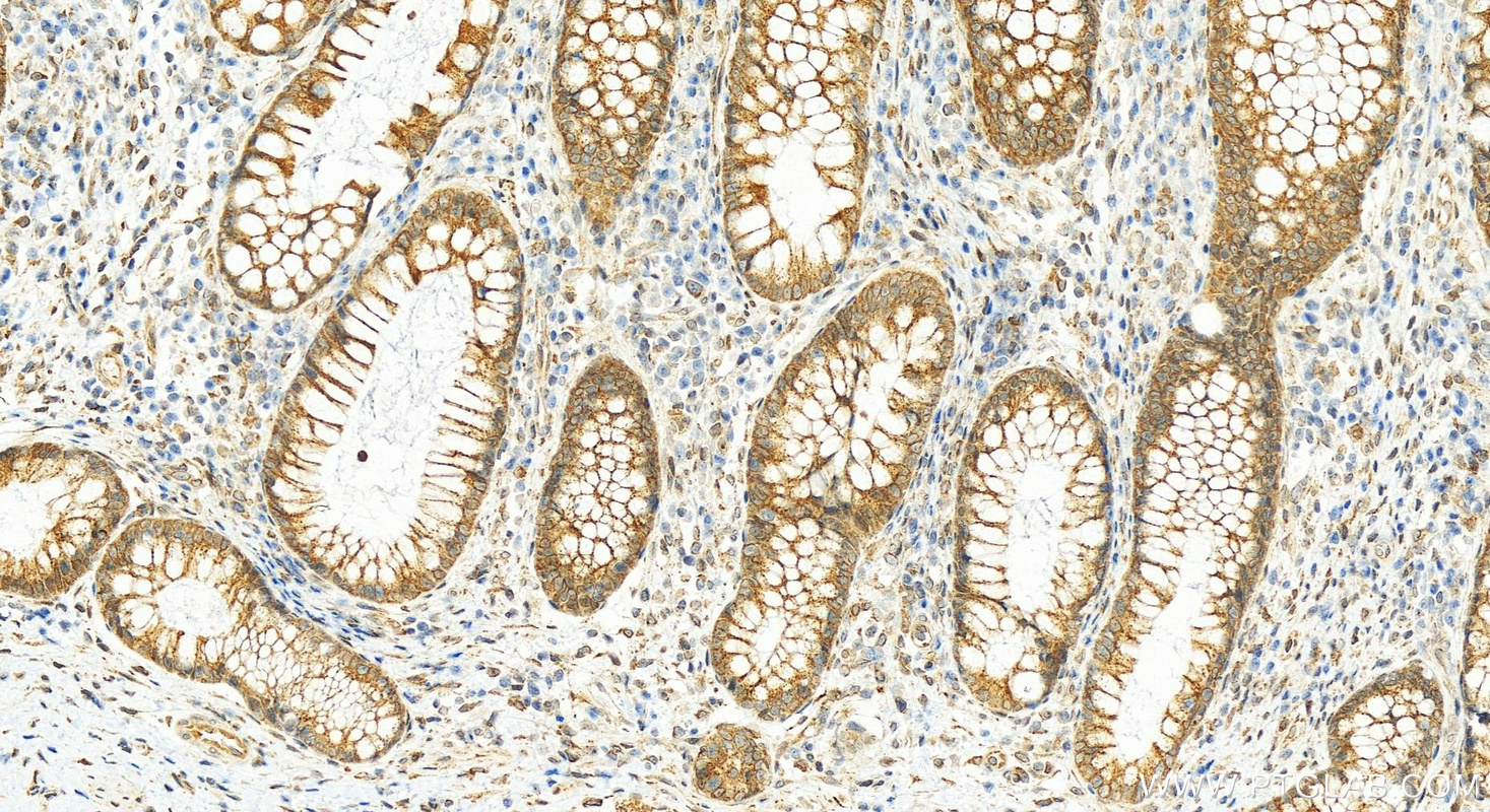 IHC staining of human colon cancer using 25122-1-AP