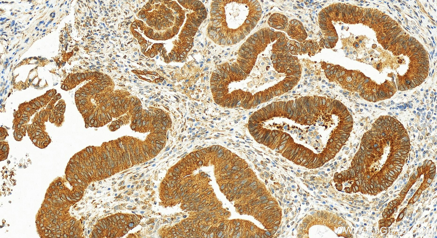 IHC staining of human colon cancer using 25122-1-AP