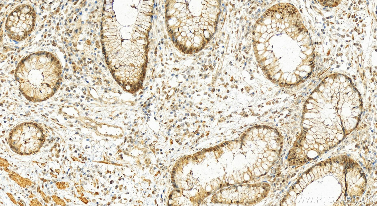 IHC staining of human colon cancer using 15912-1-AP