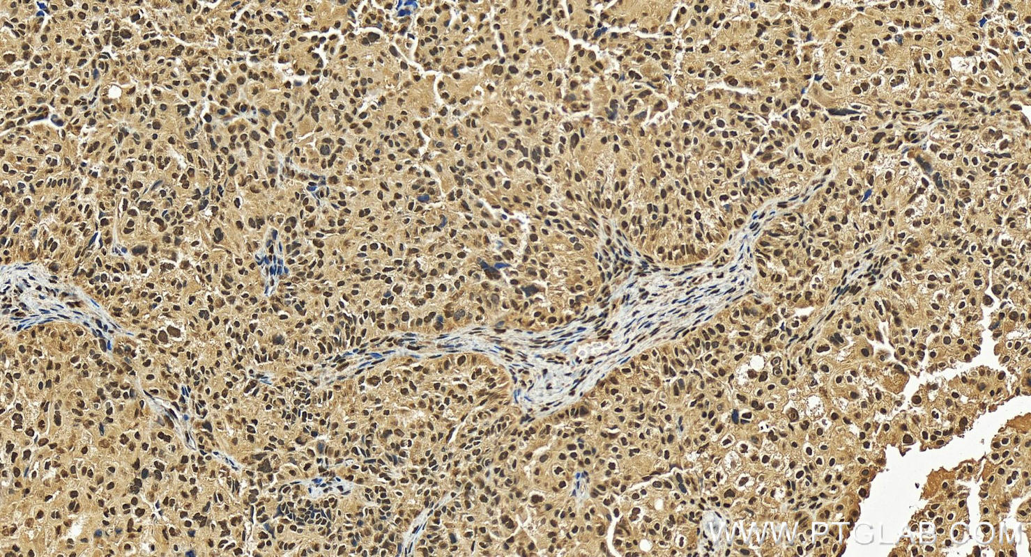 IHC staining of human ovary cancer using 12099-1-AP