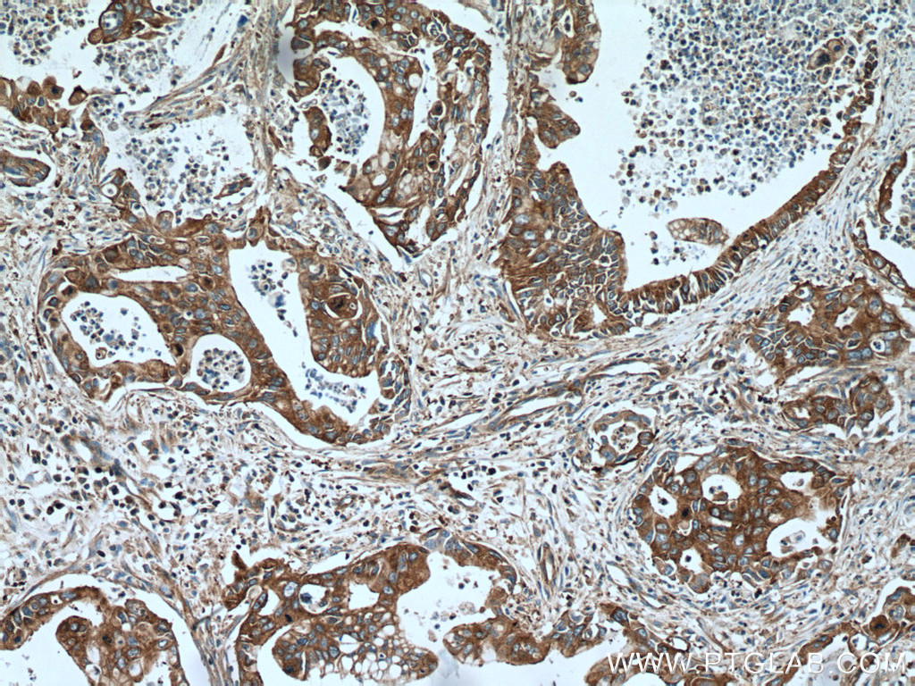 IHC staining of human pancreas cancer using 15966-1-AP (same clone as 15966-1-PBS)