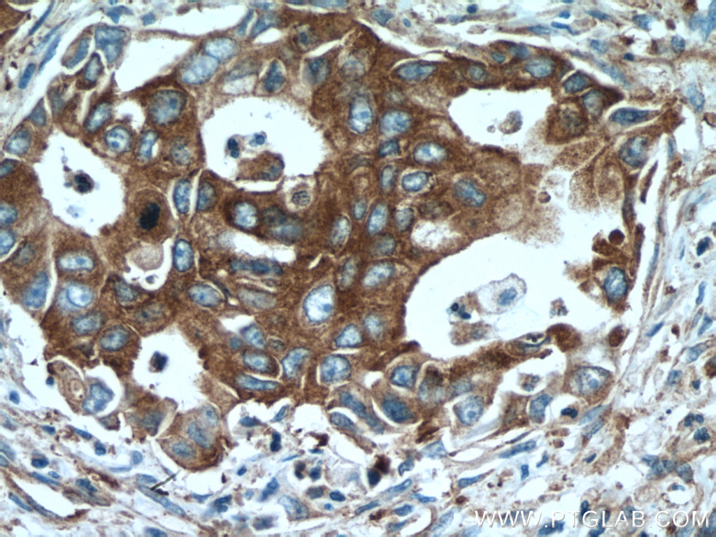 IHC staining of human pancreas cancer using 15966-1-AP (same clone as 15966-1-PBS)