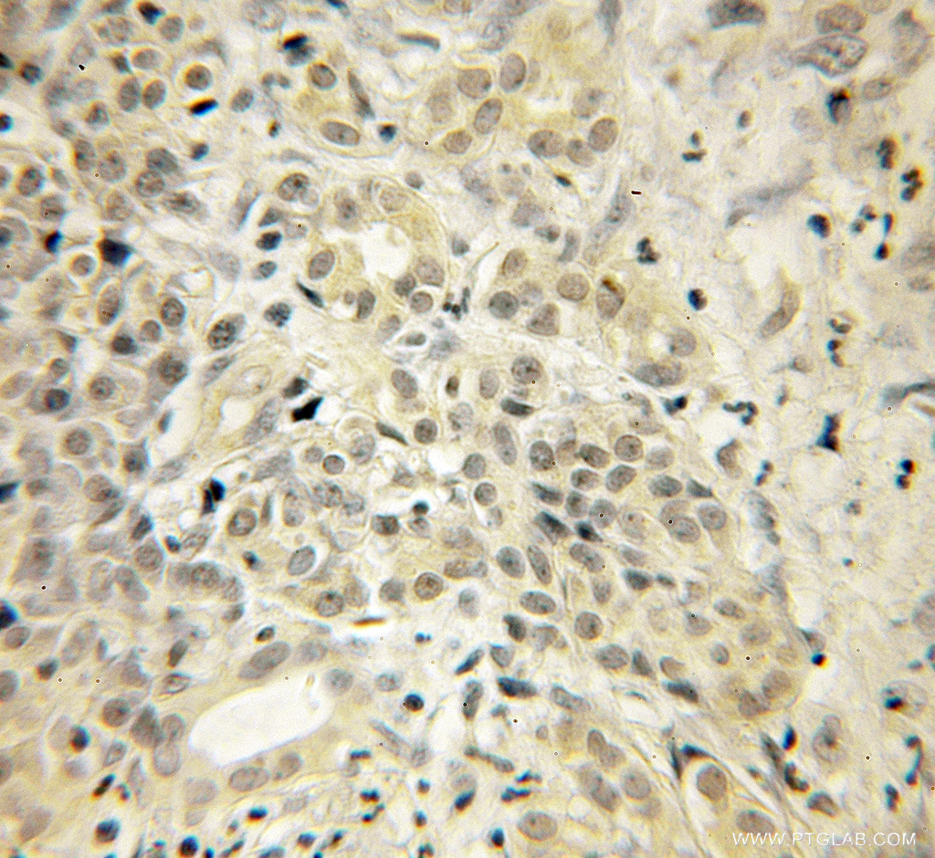 IHC staining of human pancreas cancer using 12384-1-AP