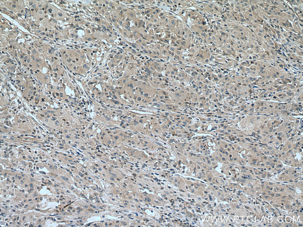 IHC staining of human liver cancer using 28762-1-AP (same clone as 28762-1-PBS)