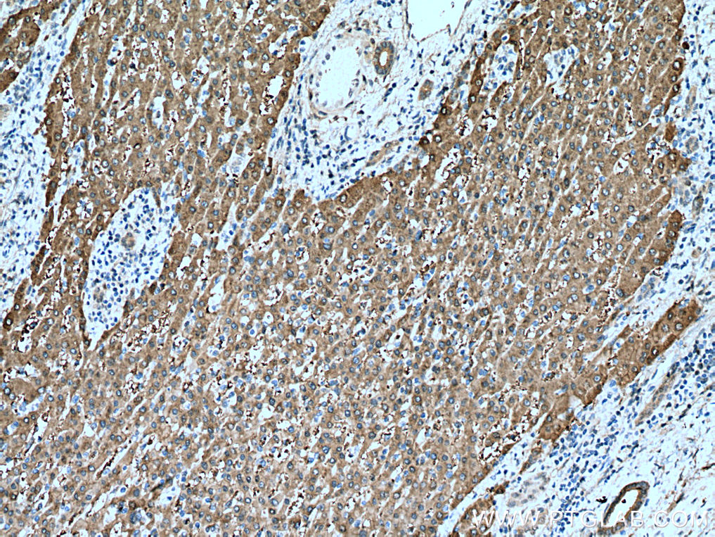 IHC staining of human liver cancer using 67360-1-Ig (same clone as 67360-1-PBS)