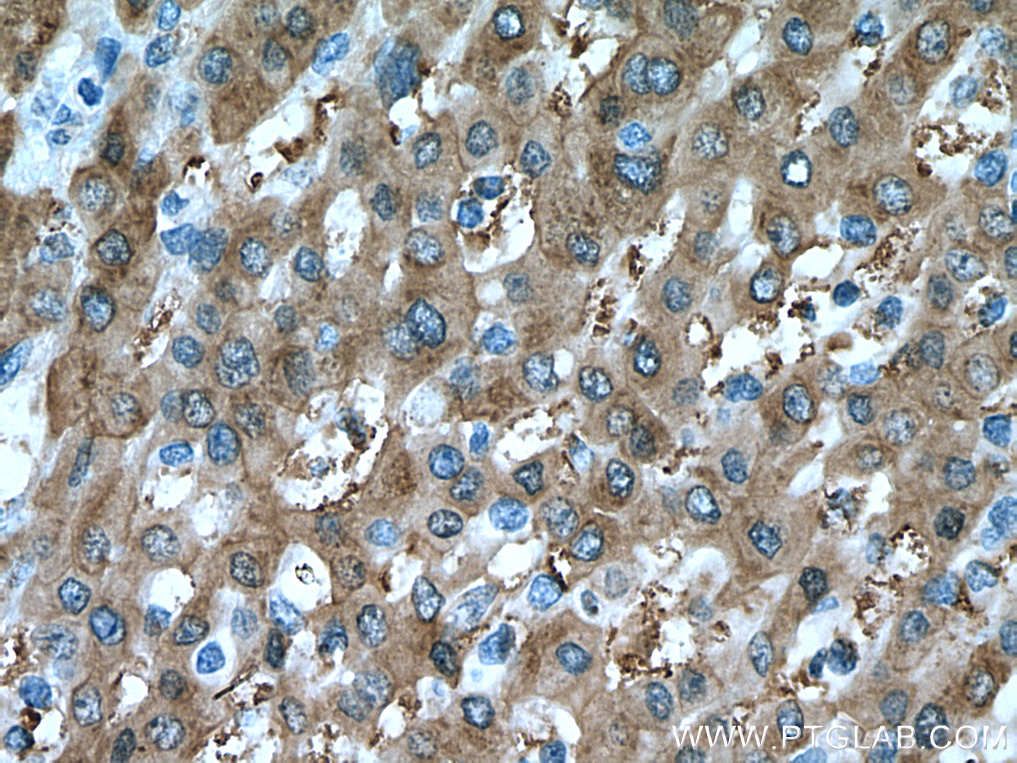 IHC staining of human liver cancer using 67360-1-Ig (same clone as 67360-1-PBS)