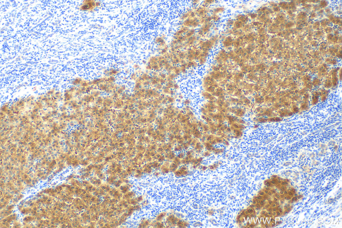 IHC staining of human liver cancer using 68381-1-Ig (same clone as 68381-1-PBS)